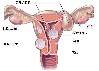 子宫肌瘤是如何在子宫内发展的？